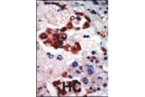 Formalin-fixed and paraffin-embedded human cancer tissue reacted with the primary antibody, which was peroxidase-conjugated to the secondary antibody, followed by AEC staining.