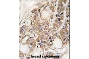 Formalin-fixed and paraffin-embedded human breast carcinoma tissue reacted with Vimentin Antibody (S82) (ABIN389211 and ABIN2839366) , which was peroxidase-conjugated to the secondary antibody, followed by DAB staining.