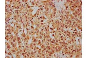 IHC image of ABIN7155258 diluted at 1:400 and staining in paraffin-embedded human liver cancer performed on a Leica BondTM system. (HRG anticorps  (AA 412-511))