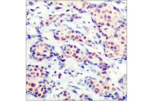 Immunohistochemical analysis of paraffin-embedded human breast carcinoma tissue using JunD(Ab-255) Antibody (JunD anticorps)