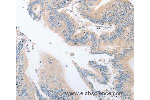 Immunohistochemistry of Human colon cancer using EPS15L1 Polyclonal Antibody at dilution of 1:30 (EPS15L1 anticorps)