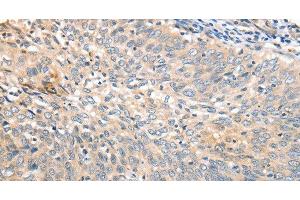 Immunohistochemistry of paraffin-embedded Human cervical cancer tissue using APTX Polyclonal Antibody at dilution 1:50