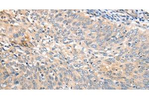 Immunohistochemistry of paraffin-embedded Human cervical cancer tissue using APTX Polyclonal Antibody at dilution 1:50 (Aprataxin anticorps)