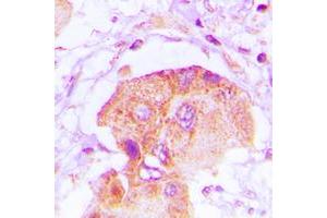 Immunohistochemical analysis of EPS8L2 staining in human lung cancer formalin fixed paraffin embedded tissue section.