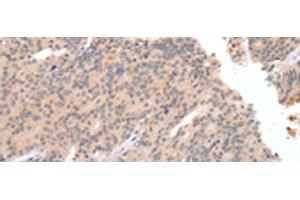 Immunohistochemistry of paraffin-embedded Human prost at e cancer tissue using DEFB112 Polyclonal Antibody at dilution of 1:40(x200)