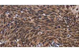 Immunohistochemistry of paraffin-embedded Human cervical cancer tissue using FASTKD5 Polyclonal Antibody at dilution 1:40 (FASTKD5 anticorps)