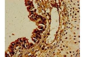Immunohistochemistry of paraffin-embedded human colon cancer using ABIN7149202 at dilution of 1:100 (CYP1A1 anticorps  (AA 97-254))