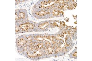 Immunohistochemistry of paraffin-embedded human colon carcinoma using MT-ND2 Rabbit pAb (ABIN7268600) at dilution of 1:50 (40x lens). (MT-ND2 anticorps  (C-Term))