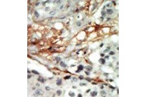 Formalin-fixed and paraffin-embedded human cancer tissue reacted with the primary antibody, which was peroxidase-conjugated to the secondary antibody, followed by AEC staining.