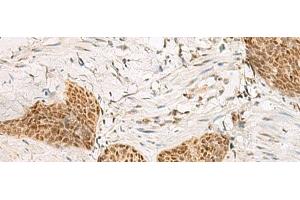 Immunohistochemistry of paraffin-embedded Human esophagus cancer tissue using PSPC1 Polyclonal Antibody at dilution of 1:30(x200) (PSPC1 anticorps)
