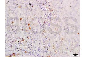 Formalin-fixed and paraffin embedded human lung carcinoma labeled with Anti-SP-D PSPD Polyclonal Antibody, unconjugated (ABIN731678) at 1:200, followed by incubation with conjugated secondary antibody and DAB staining. (SFTPD anticorps  (AA 301-375))