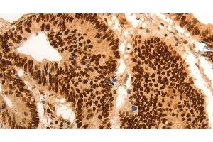 Immunohistochemistry of paraffin-embedded Human colon cancer tissue using E2F7 Polyclonal Antibody at dilution 1:60 (E2F7 anticorps)