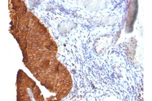 Formalin-fixed, paraffin-embedded human Bladder Carcinoma stained with Cytokeratin 19 Monoclonal Antibody (SPM561) (Cytokeratin 19 anticorps)