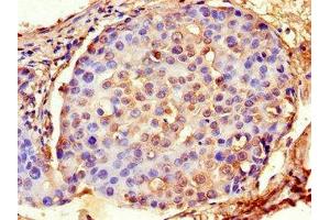 Immunohistochemistry of paraffin-embedded human breast cancer using ABIN7143140 at dilution of 1:100 (Actin, gamma 1 anticorps  (AA 13-166))
