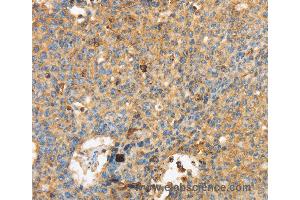 Immunohistochemistry of Human lung cancer using MAPK6 Polyclonal Antibody at dilution of 1:40 (MAPK6 anticorps)