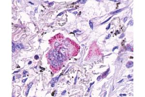 Anti-GPR48 / LGR4 antibody IHC of human Lung, Adenocarcinoma.