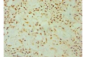 Immunohistochemistry of paraffin-embedded human breast cancer using ABIN7149891 at dilution of 1:100 (DKK4 anticorps  (AA 19-224))