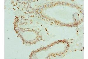 Immunohistochemistry of paraffin-embedded human breast cancer using ABIN7152086 at dilution of 1:100