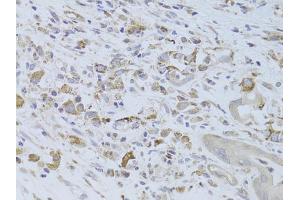 Immunohistochemistry of paraffin-embedded human breast cancer using IGF2 Antibody (ABIN6292141) at dilution of 1:100 (40x lens). (IGF2 anticorps)