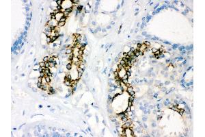 Anti-SOD2 Picoband antibody, IHC(P) IHC(P): Human Mammary Cancer Tissue (SOD2 anticorps  (C-Term))