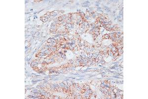 Immunohistochemistry of paraffin-embedded Human colon carcinoma using Desmoplakin antibody (ABIN6134106, ABIN6139838, ABIN6139840 and ABIN6223548) at dilution of 1:100 (40x lens).