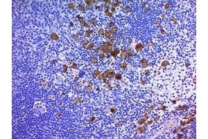 Formalin-fixed, paraffin-embedded human Hodgkin's lymphoma stained with CD30 antibody (Ber-H2 + CD30/412).