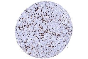 Diffuse large B cell lymphoma infiltrated by numerous CD3 positive non neoplastic lymphocytes