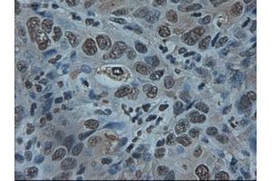Immunohistochemical staining of paraffin-embedded Carcinoma of liver using anti-ID2 (ABIN2452680) mouse monoclonal antibody. (Id2 anticorps)