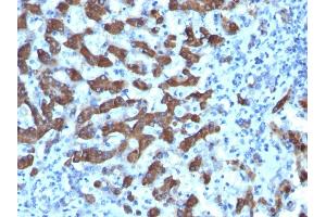 Formalin-fixed, paraffin-embedded human Hepatocellular Ca stained with CPS1 Monoclonal Antibody (CPS1/1022). (CPS1 anticorps)