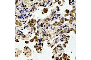 Immunohistochemical analysis of STMN1 (pS38) staining in human lung cancer formalin fixed paraffin embedded tissue section. (Stathmin 1 anticorps  (N-Term, pSer38))