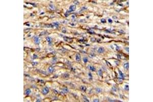 IHC analysis of FFPE human hepatocarcinoma stained with Nestin antibody
