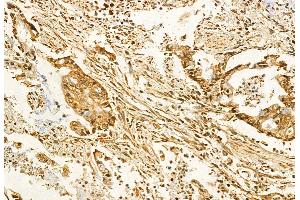 ABIN6259767 and ABIN6272861 at 1/100 staining Human pancreatic cancer by IHC-P.