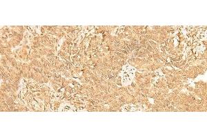 Immunohistochemistry of paraffin-embedded Human ovarian cancer tissue using ST8SIA4 Polyclonal Antibody at dilution of 1:50(x200)