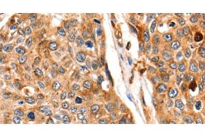 Immunohistochemistry of paraffin-embedded Human esophagus cancer tissue using Cathepsin B Polyclonal Antibody at dilution 1:140 (Cathepsin B anticorps)