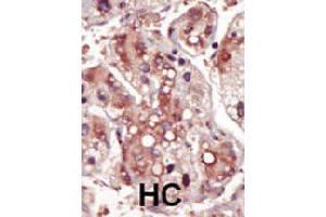 Formalin-fixed and paraffin-embedded human hepatocellular carcinoma tissue reacted with MAP2K2 polyclonal antibody  , which was peroxidase-conjugated to the secondary antibody, followed by DAB staining. (MEK2 anticorps  (AA 262-292))