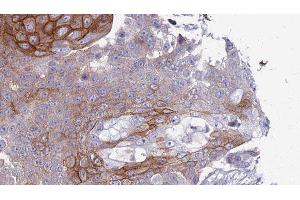 ABIN6277726 at 1/100 staining Human urothelial cancer tissue by IHC-P.