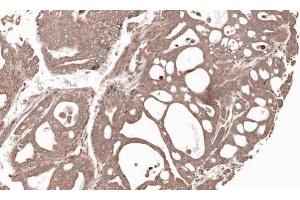 IHC-P Image Immunohistochemical analysis of paraffin-embedded Gastric CA N87 xenograft, using MMP12, antibody at 1:100 dilution. (MMP12 anticorps)