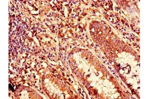 Immunohistochemistry of paraffin-embedded human colon cancer using ABIN7157408 at dilution of 1:100 (KRT81 anticorps  (AA 3-505))