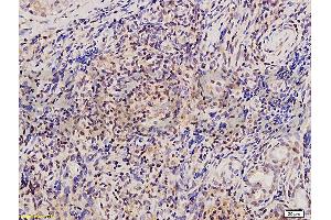 Formalin-fixed and paraffin embedded human osteosarcoma tissue labeled with Anti-Twist Polyclonal Antibody , and DAB staining (TWIST1, TWIST2 (AA 71-170) anticorps)