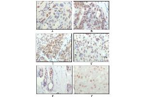 Immunohistochemical analysis of paraffin-embedded human esophageal squamous cell carcinoma (A), colon adenocarcinoma (B), liver carcinoma (C), skin carcinoma (D), breast ductal tumor (E) and brain tumor (F), showing nuclear localization using RSK1 mouse mAb with DAB staining.