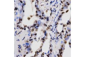 Immunohistochemistry of paraffin-embedded human lung cancer tissue using H3K4me2 antibody at dilution of 1:200 (x400 lens). (Histone 3 anticorps  (H3K4me2))
