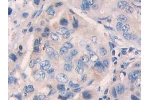 Detection of PIK3Cb in Human Breast cancer Tissue using Polyclonal Antibody to Phosphoinositide-3-Kinase Catalytic Beta Polypeptide (PIK3Cb)