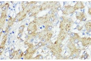 Immunohistochemistry of paraffin-embedded Human liver cancer using SOCS6 Polyclonal Antibody at dilution of 1:100 (40x lens).
