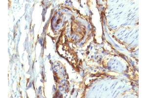 Formalin-fixed, paraffin-embedded human Colon Carcinoma stained with CD34 Monoclonal Antibody (QBEnd/10 + HPCA1/763) (CD34 anticorps)