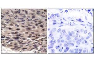Immunohistochemical analysis of paraffin-embedded human breast carcinoma tissue using FKHRL1 (phospho-Ser253) antibody (E011222). (eIF4EBP1 anticorps  (pThr36))