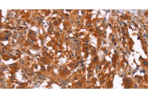 Immunohistochemistry of paraffin-embedded Human thyroid cancer using HAS1 Polyclonal Antibody at dilution of 1:30 (HAS1 anticorps)