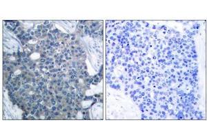 Immunohistochemical analysis of paraffin-embedded human breast carcinoma tissue using Stathmin 1 (Ab-24) antibody (E021217). (Stathmin 1 anticorps)