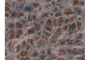 Detection of PSMD9 in Human Liver cancer Tissue using Polyclonal Antibody to Proteasome 26S Subunit, Non ATPase 9 (PSMD9)