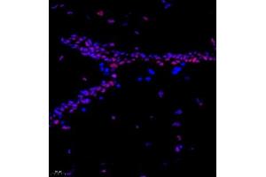 Immunofluorescence of paraffin embedded human breast cancer using CITED4 (ABIN7073356) at dilution of 1:2200 (400x lens) (CITED4 anticorps)