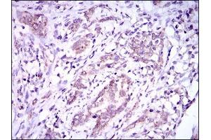 Immunohistochemical analysis of paraffin-embedded cervical cancer tissues using DNAL4 mouse mAb with DAB staining.